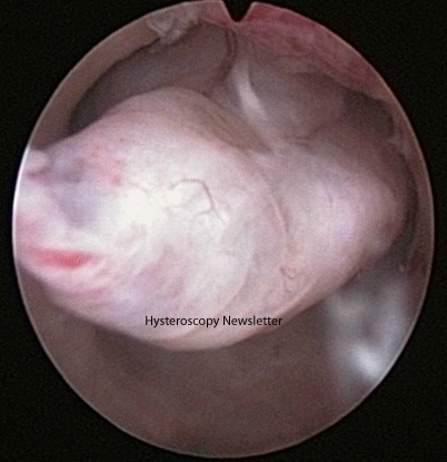 Endometrial polyp 2 copia.jpg